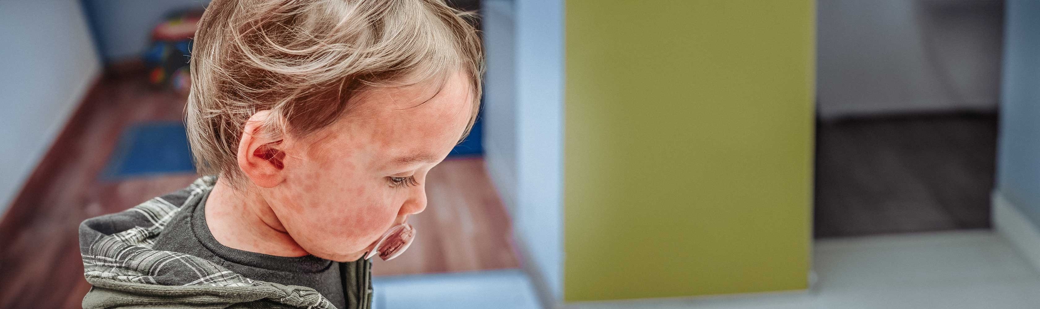 Masern - Kleinkind mit einem Schnuller hat die Maser und darum Ausschlag am ganzen Körper