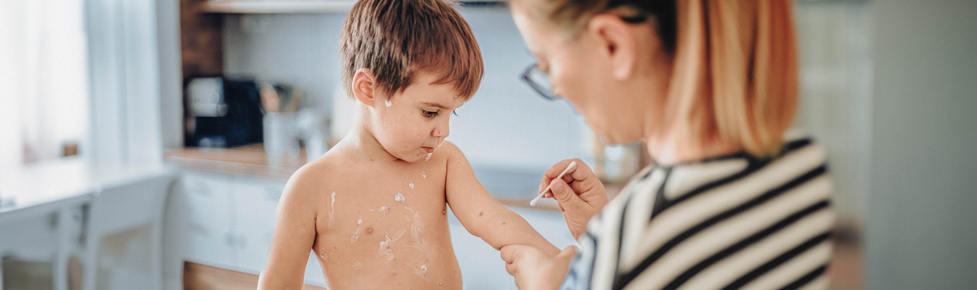 Windpocken - Mutter streicht Salbe mit einem Stäbchen auf die Windpocken ihre Sohnes