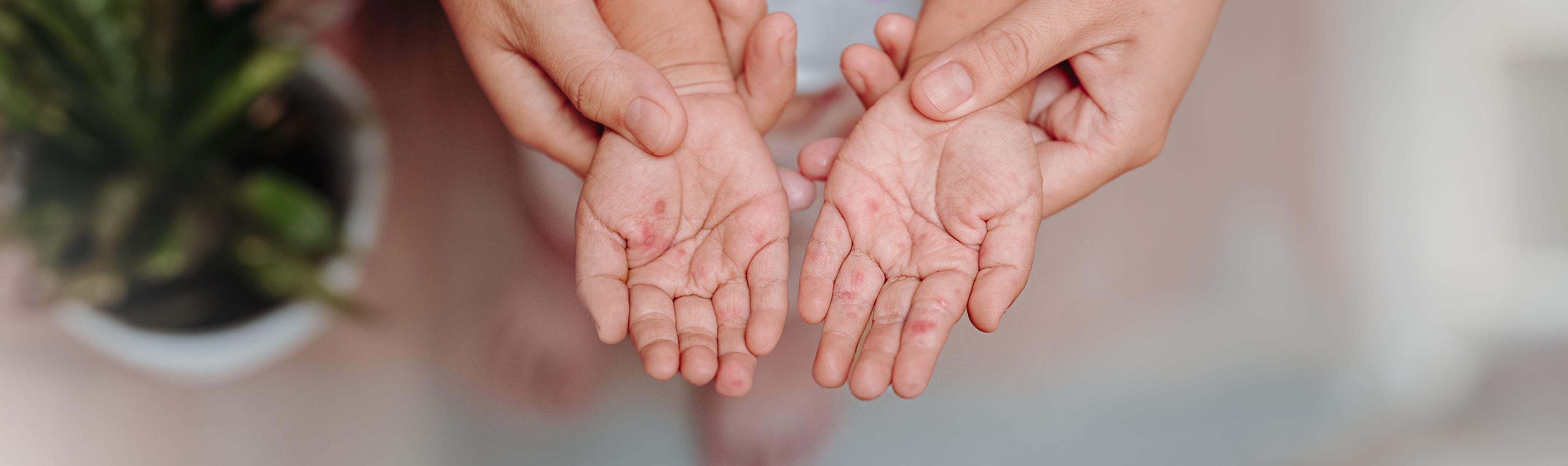 Hand-Fuss-Mundkrankheit - Kleine Kinderhände mit Ausschlag