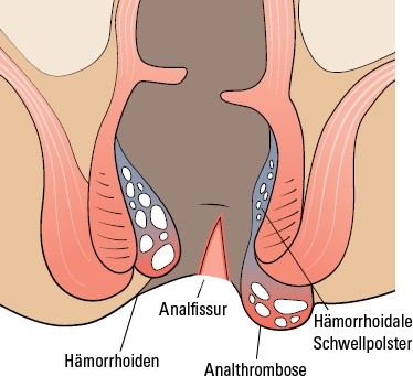 Analfissur und Venenthrombose