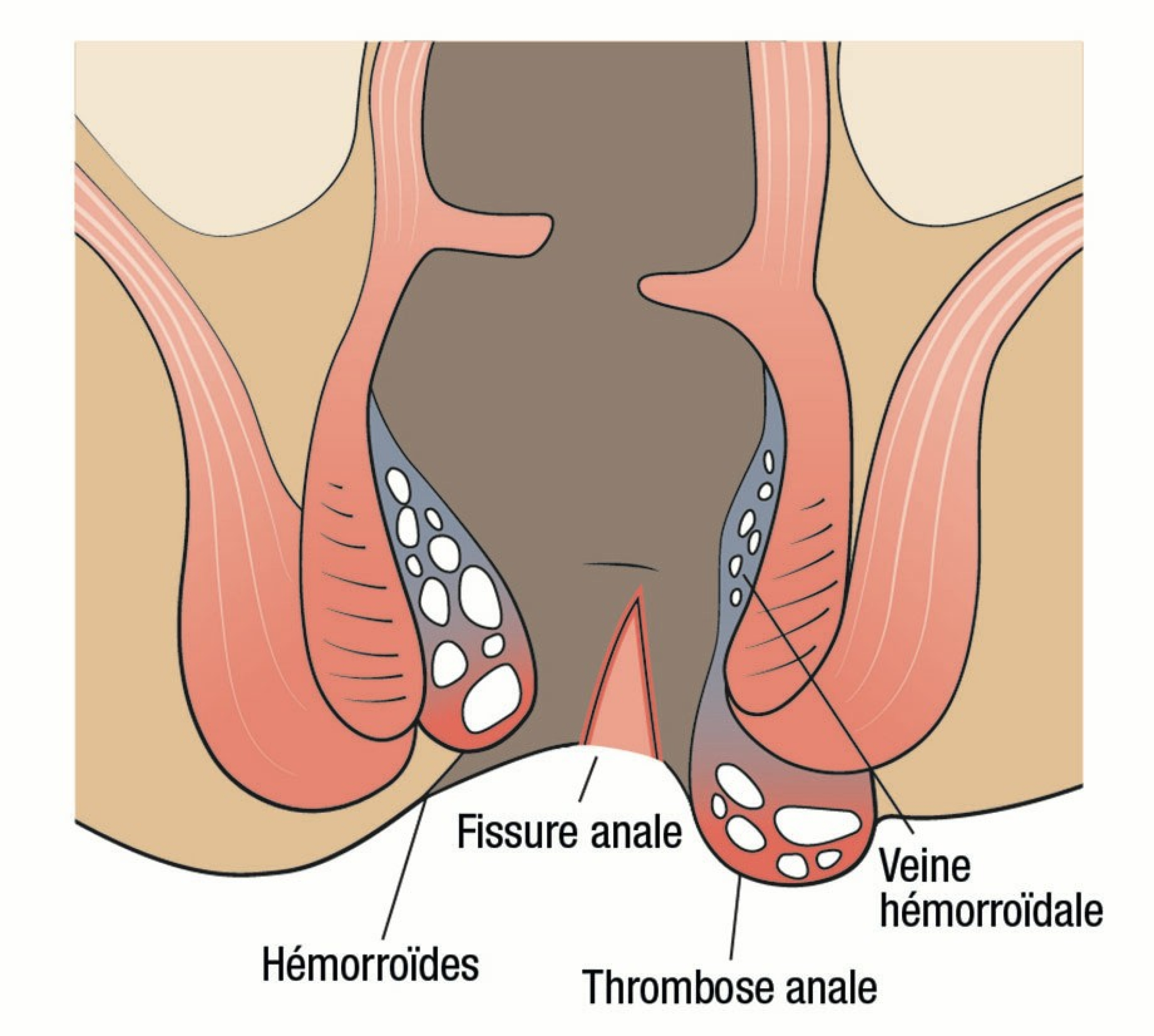 Fissure anale et thrombose veineuse périanale