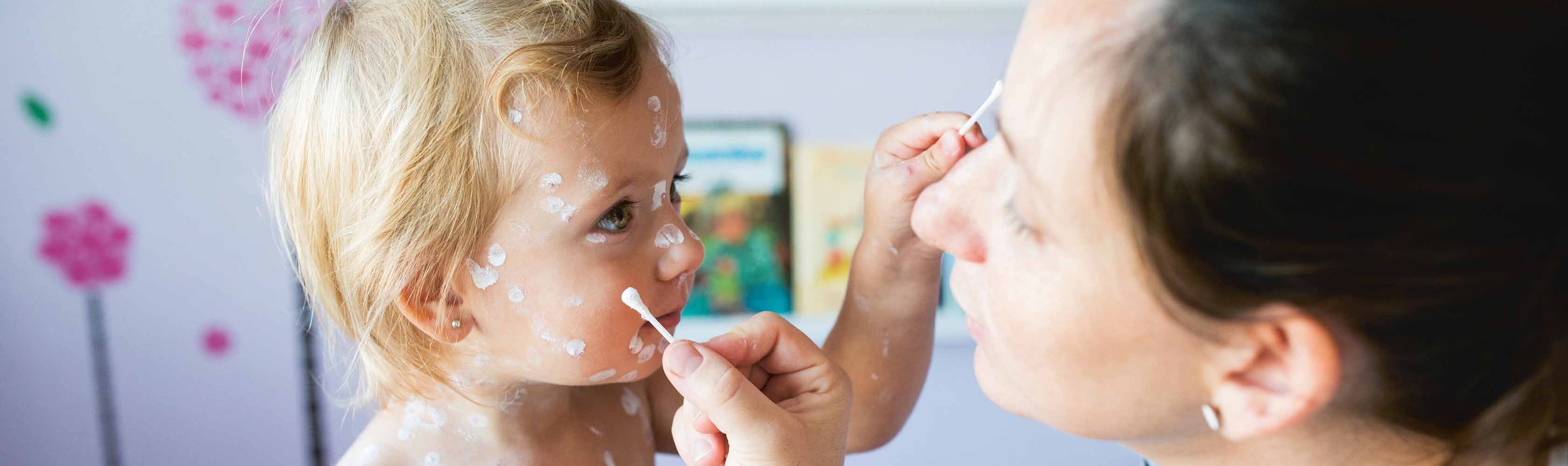 Una mamma applica una lozione anti-prurito alla figlioletta affetta da varicella.
